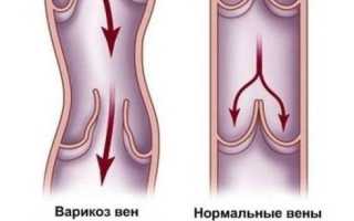 Беременность и варикоз половых губ – почему возникает патология?
