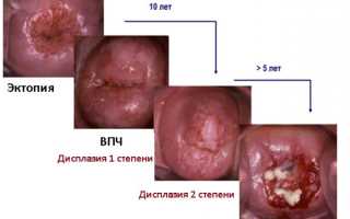 Дисплазия — это что такое? Дисплазия шейки матки: диагностика и лечение