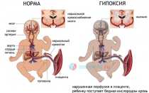 Гипоксически-ишемическое поражение ЦНС, энцефалопатия у новорожденных